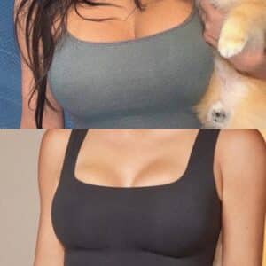 Reducción de pecho
